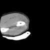 SPORK, NICO - 22.03.1976 - 02.08.2022 - CT obere Extremität - 17:56:57